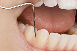歯周病のための定期検診