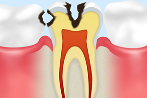 C2【象牙質の虫歯】
