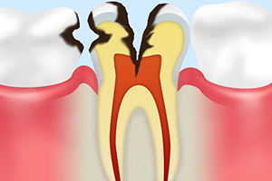 C3【神経まで達した虫歯】