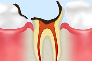 C4【歯根まで達した虫歯】