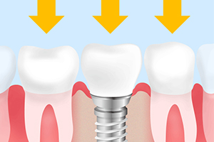 インプラント