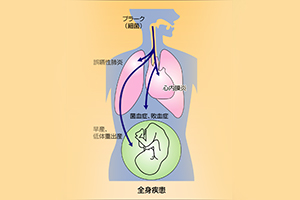 歯周病が引き起こす全身への悪影響