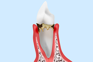 軽度歯周炎