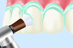 PMTC(Professional Mechanical Tooth Cleaning)